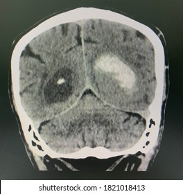 The Picture Of Brain Computed Tomography Of A Human That Have Intracerebral Hemorrhage And Intraventricular Hemorrhage At Left Thalamus ,Medical Technology And Science Concept. Coronal View View View.