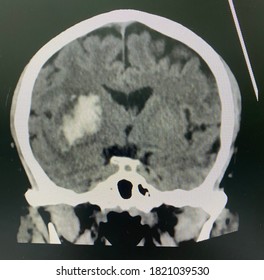 The Picture Of Brain Computed Tomography Of A Human That Have Intracerebral Hemorrhage And Intraventricular Hemorrhage At Left Thalamus ,Medical Technology And Science Concept. Coronal View.