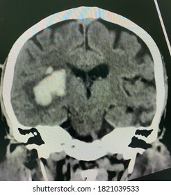 The Picture Of Brain Computed Tomography Of A Human That Have Intracerebral Hemorrhage And Intraventricular Hemorrhage At Left Thalamus ,Medical Technology And Science Concept. Coronal View.