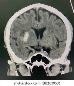 The Picture Of Brain Computed Tomography Of A Human That Have Intracerebral Hemorrhage And Intraventricular Hemorrhage At Left Thalamus ,Medical Technology And Science Concept. Coronal View.