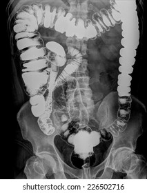 Picture Of The Colon Xray