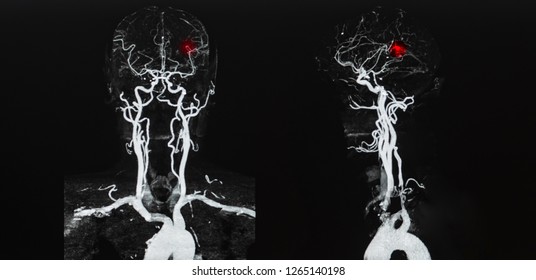 Picture Of Computer Tomography Angiogram CTA That Shown Blood Vessel Supply To Brain . If Aneurysm Occurs Patient Had The Weakness Of Limb . Hemiparesis Related To Hypertension . AP And Lateral View. 
