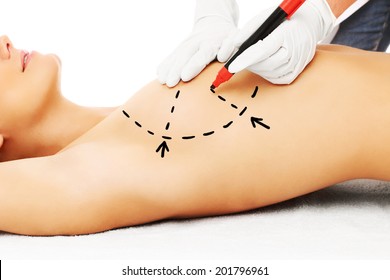 A Picture Of A Doctor Marking Breast For Surgery