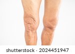 Picture of an elderly man leg with symptom of weak knee joint.