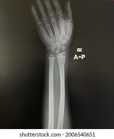 The picture of film x-ray right hand  of patient who have distal end radius fracture, Medical Technology and Science concept. - Shutterstock ID 2006540651