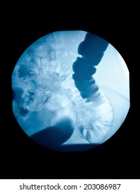 Picture Of Intestinal Abdominal Xray