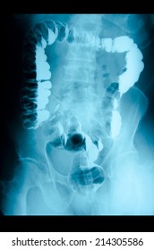 Picture Of Intestinal Abdominal Xray