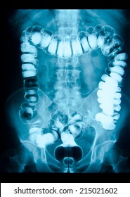 Picture Of Intestinal Abdominal Xray