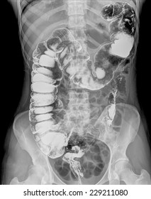 Picture Of Intestinal Abdominal Xray