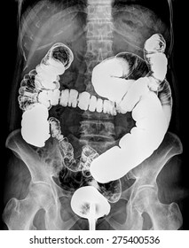 Picture Of Intestinal Abdominal Xray