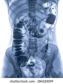 Picture Of Intestinal Abdominal Xray