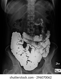 Picture Of Intestinal Abdominal Xray