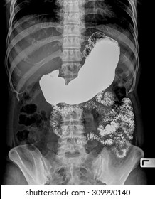 Picture Of Intestinal Abdominal Xray