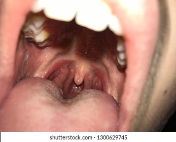 Mononucleosis High Res Stock Images Shutterstock