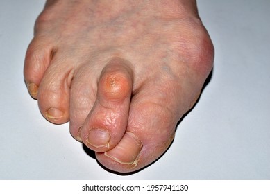 The picture shows a close-up of the right foot of the leg affected by the disease, the hallux valgus, the toes are twisted.