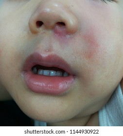 A Picture Of Skin Infection As Cellulitis On The Face Showed Small Red Bump Or Mass Below The Left Side Of Nose Swollen Painful With Radiate To The Side Involving Swollen Cheek Next To The Lesion