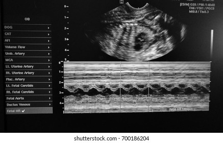 A Picture Of  Ultrasound Of Dog Fetal Heart Rate 