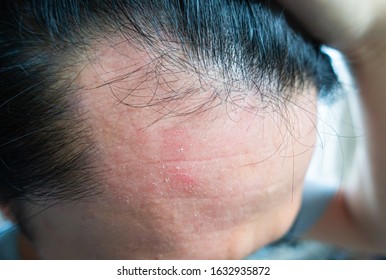 Pictures Of Atopy And Dermatosis