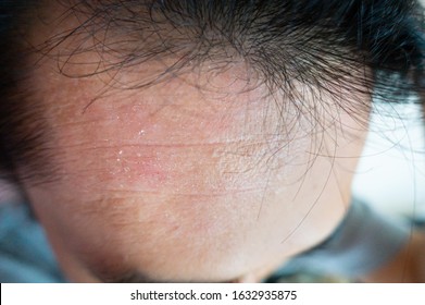 Pictures Of Atopy And Dermatosis