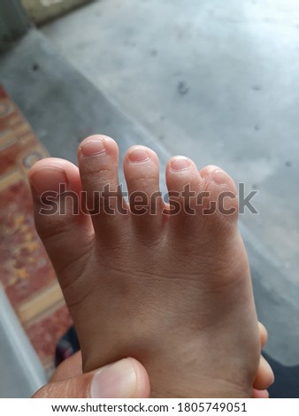 pictures of toes connected from birth