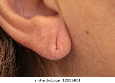 Pierced Earlobe Close Up, Stretched External Ear Skin With Former Piercing Hole Mark