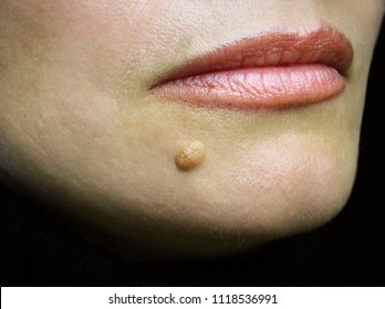Pigment nevus on the face - the big mole on the skin of the chin