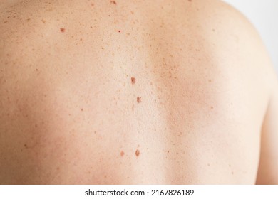 Pigmentation. Close Up Detail Of The Bare Skin On A Man Back With Scattered Moles And Freckles. Checking Benign Moles. Birthmarks On Skin