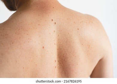 Pigmentation. Close Up Detail Of The Bare Skin On A Man Back With Scattered Moles And Freckles. Checking Benign Moles. Birthmarks On Skin