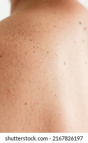 Pigmentation. Close Up Detail Of The Bare Skin On A Man Back With Scattered Moles And Freckles. Checking Benign Moles. Birthmarks On Skin