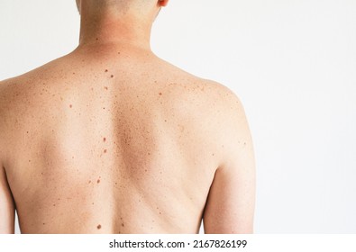 Pigmentation. Close Up Detail Of The Bare Skin On A Man Back With Scattered Moles And Freckles. Checking Benign Moles. Birthmarks On Skin