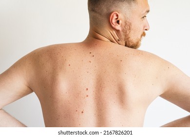 Pigmentation. Close Up Detail Of The Bare Skin On A Man Back With Scattered Moles And Freckles. Checking Benign Moles. Birthmarks On Skin