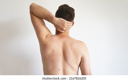 Pigmentation. Close Up Detail Of The Bare Skin On A Man Back With Scattered Moles And Freckles. Checking Benign Moles. Birthmarks On Skin