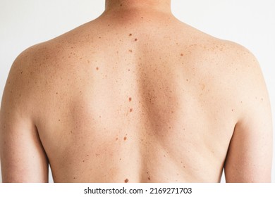 Pigmentation. Close Up Detail Of The Bare Skin On A Man Back With Scattered Moles And Freckles. Checking Benign Moles. Birthmarks On Skin