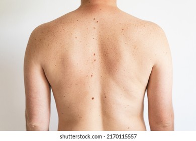 Pigmentation. Close Up Detail Of The Bare Skin On A Man Back With Scattered Moles And Freckles. Checking Benign Moles. Birthmarks On Skin