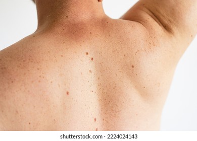 Pigmentation. Close Up Detail Of The Bare Skin On A Man Back With Scattered Moles And Freckles. Checking Benign Moles. Birthmarks On Skin