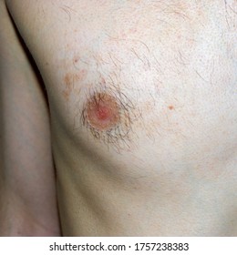 Pigmentation. Problem Skin. Hyper Pigmentation On The Male Chest.