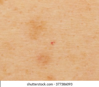 Liver Spots Images Stock Photos Vectors Shutterstock