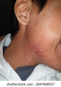 Pimple Acne Allergic Skin Redness On Bellow The Jaw