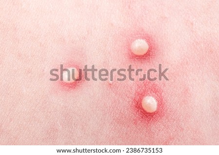 Pimple, acne or comedones. Inflamed pimples, pustules, cysts. Infection on skin. Popping pimple. Inflammatory elements, eruptions, acne lesions, acne processes, acne rash. Skin care. Medical clinic