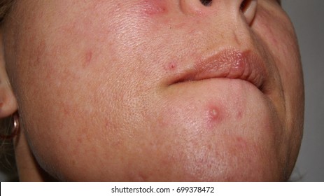 胸 ニキビ の写真素材 画像 写真 Shutterstock 胸 ニキビ の写真素材 画像 写真 Shutterstock
