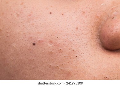 youtube blackheads on the cheeks