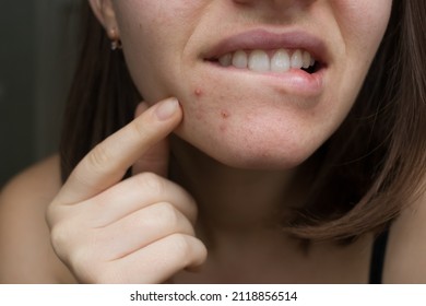 pimple on girl's chin. acne problem.
