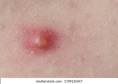 pimple on skin infection Pimple to Popping