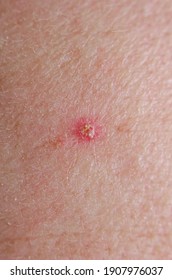 A Pimple On The Very Dry Skin