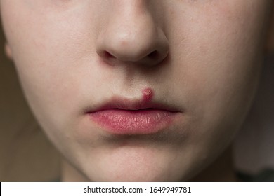 
Pimple Over A Girl’s Lip