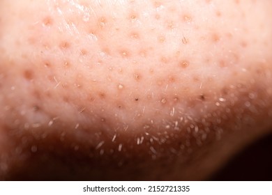 Pimples, Clogged Acne Around The Nose Of Men