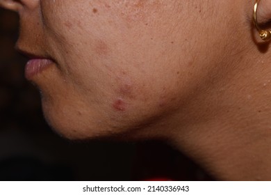 Pimples, Dark Spots And Open Pores On Face Closeup Background