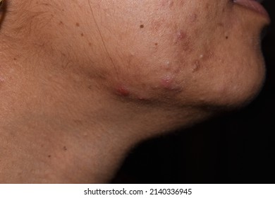 Pimples, Dark Spots And Open Pores On Face Closeup Background