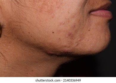 Pimples, Dark Spots And Open Pores On Face Closeup Background