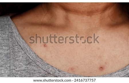 Pimples on the skin of the chest,A woman suffering from pimples on her chest skin,acne close-up on the female breast, problematic teenage skin